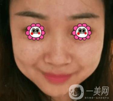 岳陽(yáng)市第一人民醫(yī)院整形美容科祛斑好嗎？?jī)r(jià)格表和案例日記分享