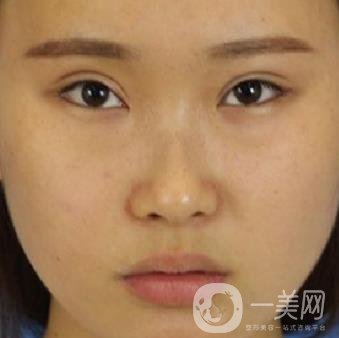 河北省中醫(yī)院整形美容科隆鼻怎么樣？?jī)r(jià)格表及術(shù)后恢復(fù)日記分享