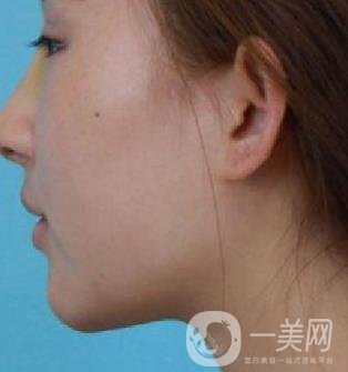 河北省中醫(yī)院整形美容科隆鼻怎么樣？?jī)r(jià)格表及術(shù)后恢復(fù)日記分享