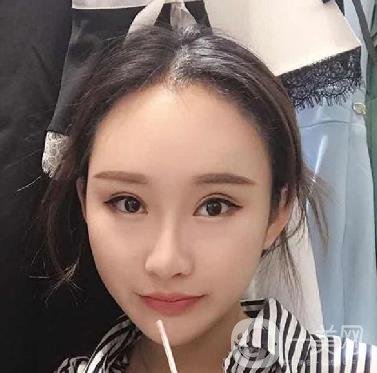 河北省中醫(yī)院整形美容科隆鼻怎么樣？?jī)r(jià)格表及術(shù)后恢復(fù)日記分享