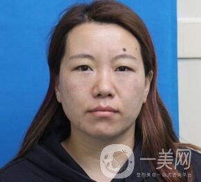 贛州市人民醫(yī)院整形科價格表，附祛眼袋案例分享