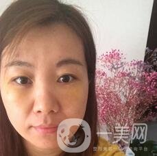 贛州市人民醫(yī)院整形科價格表，附祛眼袋案例分享