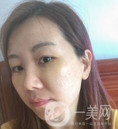 贛州市人民醫(yī)院整形科價格表，附祛眼袋案例分享