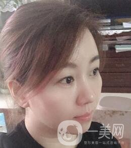 贛州市人民醫(yī)院整形科價格表，附祛眼袋案例分享