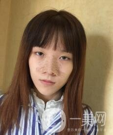 南昌二附院整形科價格表2020，附肋軟骨隆鼻整形案例