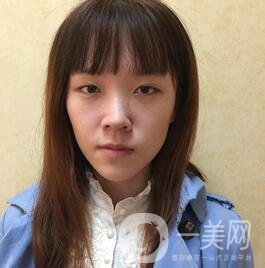 南昌二附院整形科價格表2020，附肋軟骨隆鼻整形案例