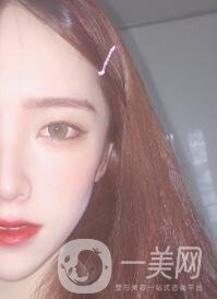 南昌二附院整形科價格表2020，附肋軟骨隆鼻整形案例