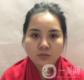 景德鎮(zhèn)第一人民醫(yī)院整形科價格表，附面部吸脂瘦臉案例