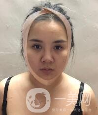 景德鎮(zhèn)第一人民醫(yī)院整形科價格表，附面部吸脂瘦臉案例