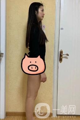 福建省立醫(yī)院整形科價(jià)格(目)表2020，附大小腿吸脂案例