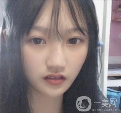 北京醫(yī)院趙紅藝做鼻子多少錢?價格表和真人*果變化圖一覽