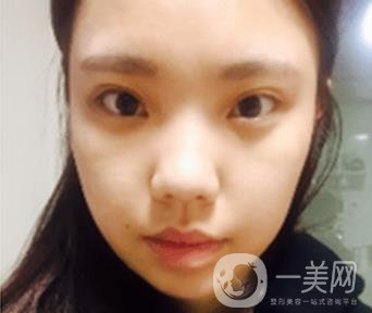 西安唐都醫(yī)院價格表價目表，內(nèi)附吳瓊隆鼻整形日記