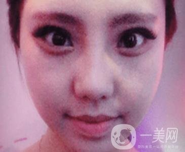 西安唐都醫(yī)院價格表價目表，內(nèi)附吳瓊隆鼻整形日記