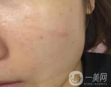 西安市中心醫(yī)院整形科價(jià)目價(jià)格一覽，附陶諫祛疤案例*果圖