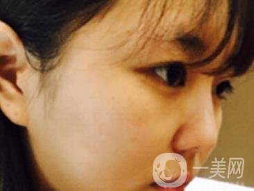 廣州博仕整形醫(yī)院做鼻子多少錢?價格表和整形恢復(fù)日記一覽