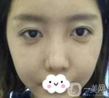 泉州二院整形外科可以打玻尿酸嗎？附價格表及玻尿酸隆鼻案例