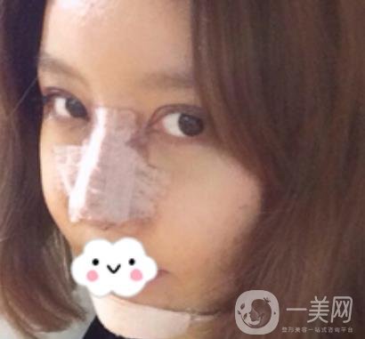 泉州二院整形外科可以打玻尿酸嗎？附價格表及玻尿酸隆鼻案例