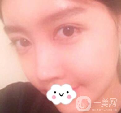 泉州二院整形外科可以打玻尿酸嗎？附價格表及玻尿酸隆鼻案例