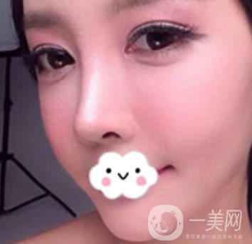 泉州二院整形外科可以打玻尿酸嗎？附價格表及玻尿酸隆鼻案例