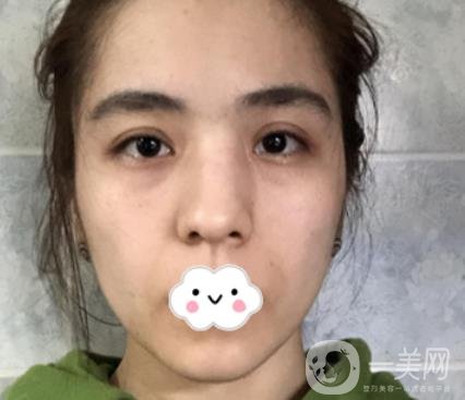 上海伯思立整形怎么樣？附沈國(guó)雄隆鼻案例及整形價(jià)格表