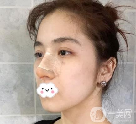 上海伯思立整形怎么樣？附沈國(guó)雄隆鼻案例及整形價(jià)格表