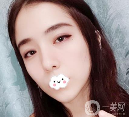 上海伯思立整形怎么樣？附沈國(guó)雄隆鼻案例及整形價(jià)格表