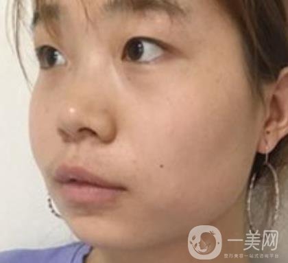 上海華美李志海磨骨多少錢？案例有嗎？整形價(jià)格表一覽