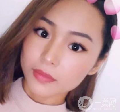 上海九院切下頜角手術(shù)經(jīng)歷分享，附2020整形價(jià)格一覽表