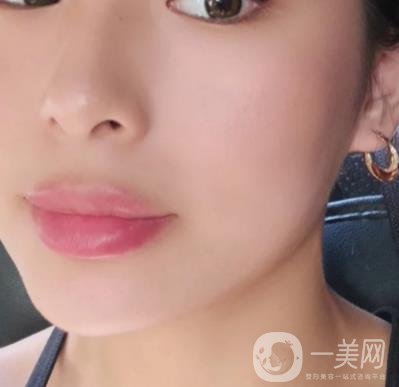 上海九院切下頜角手術(shù)經(jīng)歷分享，附2020整形價(jià)格一覽表