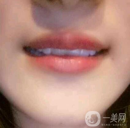 北京市海淀醫(yī)院整牙多少錢？看價格表及案例*果