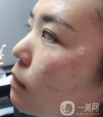 吉大一院整形美容科價格表費用明細，附祛斑案例