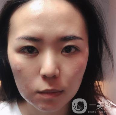 吉大一院整形美容科價格表費用明細，附祛斑案例