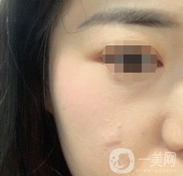 河北省中醫(yī)院整形美容科去疤*果如何？?jī)r(jià)格表及案例實(shí)拍圖公布