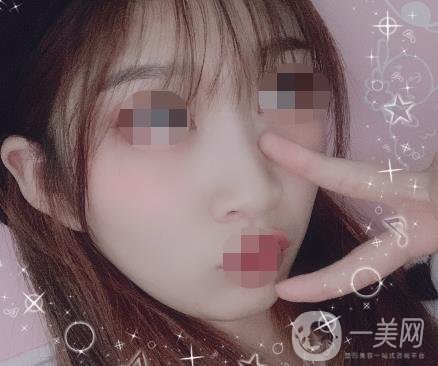 河北省中醫(yī)院整形美容科去疤*果如何？?jī)r(jià)格表及案例實(shí)拍圖公布