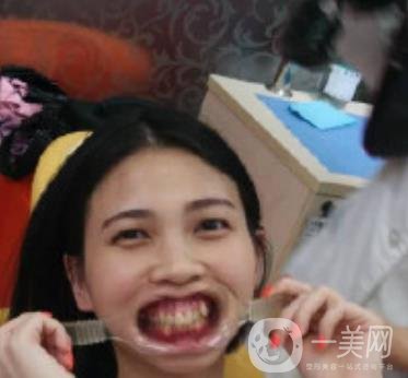 南昌大學(xué)第二附屬醫(yī)院整牙60天案例，還有價(jià)格表哦