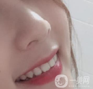 南昌大學(xué)第二附屬醫(yī)院整牙60天案例，還有價(jià)格表哦