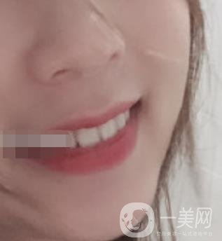 南昌大學(xué)第二附屬醫(yī)院整牙60天案例，還有價(jià)格表哦