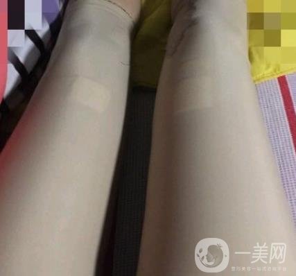 鹽城東方女子整形醫(yī)院價格表_抽脂瘦身案例