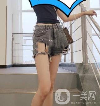 鹽城東方女子整形醫(yī)院價格表_抽脂瘦身案例