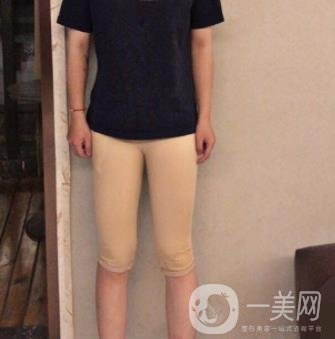 鹽城東方女子整形醫(yī)院價格表_抽脂瘦身案例