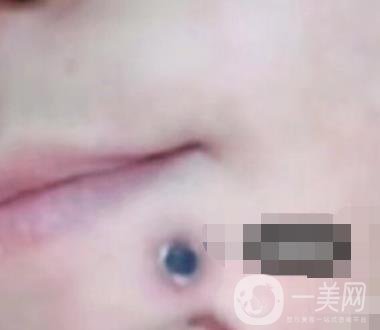 蘭州軍區(qū)陸軍總院皮膚科價(jià)格表_祛痣案例展示