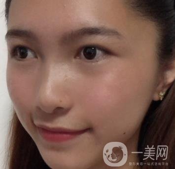 沈陽軍區(qū)總醫(yī)院整形外科價(jià)格表2020，附雙眼皮案例