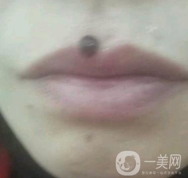 鹽城東方女子整形醫(yī)院價(jià)格表_點(diǎn)痣*果一覽