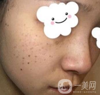 浙二醫(yī)院整形美容科價(jià)格表*新版，附激光祛斑*終*果圖