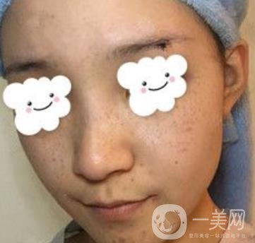 浙二醫(yī)院整形美容科價(jià)格表*新版，附激光祛斑*終*果圖