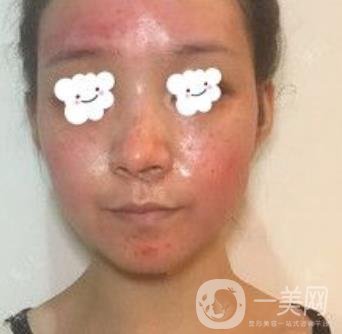 浙二醫(yī)院整形美容科價(jià)格表*新版，附激光祛斑*終*果圖