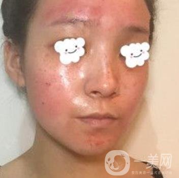 浙二醫(yī)院整形美容科價(jià)格表*新版，附激光祛斑*終*果圖