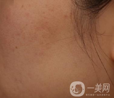 南通維多利亞美容醫(yī)院怎么樣?價格表收費項目和祛痘*果實拍圖