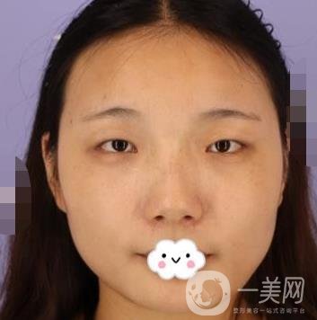 北京安貞醫(yī)院整容怎么樣？李斌斌修復雙眼皮怎么樣？內(nèi)含案例及價格表