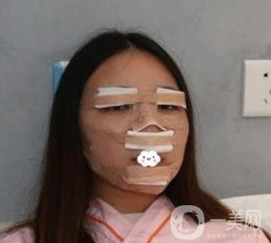 北京安貞醫(yī)院整容怎么樣？李斌斌修復雙眼皮怎么樣？內(nèi)含案例及價格表